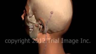 Hydrocephalus shunt video by Dr Cal Shipley MD [upl. by Nashom]