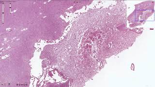 Encephalomalacia  Histopathology [upl. by Kym597]