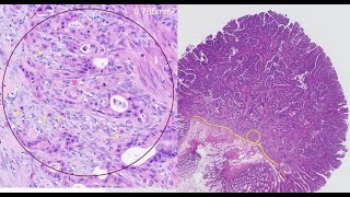 Implementation guidance for reporting of colorectal cancer [upl. by Gorrian936]