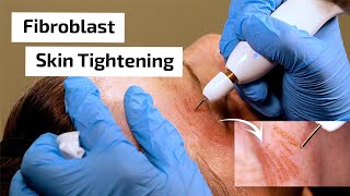 What is Fibroblast Skin Tightening  Prime Plasma [upl. by Nilyak418]