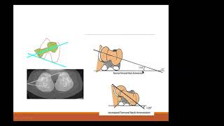 ANTEVERSION FEMORAL Y TORSION TBIAL [upl. by Elder538]