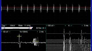 Myokymic discharges doublets triplets in facial nerve lesion [upl. by Anak]