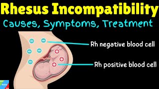 Rhesus Incompatibility  Rh Incompatibility in Pregnancy – Causes Symptoms Diagnosis amp Treatments [upl. by Tezil919]