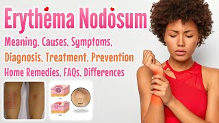 Erythema Nodosum meaning causes symptoms diagnosis treatment prevention home remedies FAQs [upl. by Nolyk998]