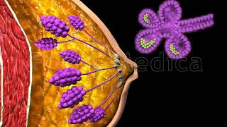 Epithelial Hyperplasia of the Breast  Animated Atlas of Breast and Gastric Cancer [upl. by Faxun]