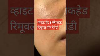 Whitehead removal home remedy  remove whiteheads permanently whiteheadremoval blackheadremoval [upl. by Schafer]