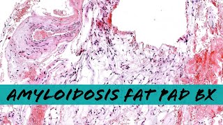 Systemic Amyloidosis on abdominal fat pad biopsy with Congo red stain pathology dermatopathology [upl. by Harriot]