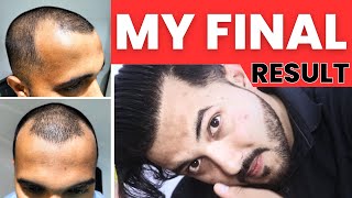 Journey Of My Full Hair Transplant Result After 1 Year  Best Hair Transplant Result In India 2023 [upl. by Farl]