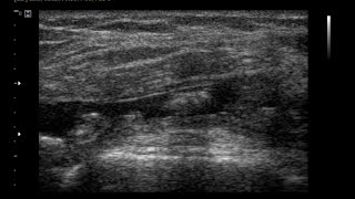 Chronic Synovitis Knee Joint  Effusion Joint  Hypertrophid Synovial [upl. by Yhtak]