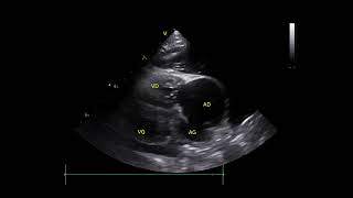 Eisenmengers syndrome and an atrial septal defect in young 🐈 [upl. by Eecart]