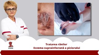 Tratarea ranilor 👉 Eczema suprainfectata a piciorului [upl. by Now607]