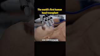 The world’s first human nead transplanthead change techical success youtube foryou fyp [upl. by Arahc266]