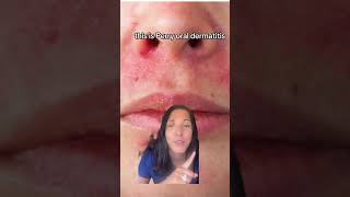 Dermatologist explains Perioral Dermatitis perioraldermatitis [upl. by Ardys878]