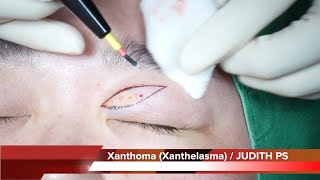 Xanthoma Xanthelasma removal surgery 안검황색종 [upl. by Nodaj]