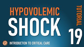 Hypovolemic Shock [upl. by Verlee]