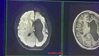 Crisis convulsivas en niños epilepsia por infarto cerebral perinatal [upl. by Yahska]