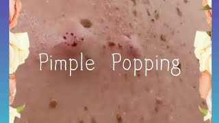 Pimple amp Blackheads Popping  39 [upl. by Anivle73]