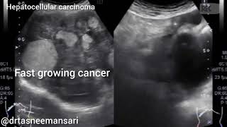 Liver cancer I Hepatic cancer I Hepatocellular carcinoma I Malignant hepatoma [upl. by Niamor]