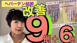 ヘバーデン結節改善9例！リウマチなどその他6例も♪ [upl. by Waly]