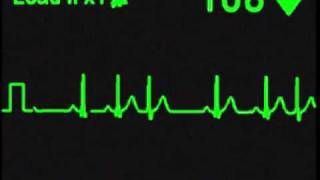 Nodal Trigeminy  ECG Simulator  Arrhythmia Simulator [upl. by Doowrehs]