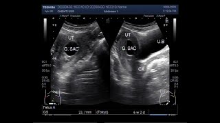 Ultrasound Video showing an empty Gestational sac in pregnancy of about 6 weeks 2 days [upl. by Leumhs73]