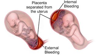 What is antepartum haemorrhage😷How to manage APHdrsaminakhurshidgynaecolog4661 [upl. by Yarrum790]