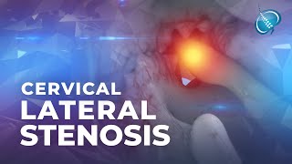 What is Cervical Lateral Stenosis  Foraminal Stenosis [upl. by Haelhsa403]