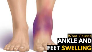 What Causes Ankles amp Feet Swelling  Diagnosis amp Treatment [upl. by Augie]