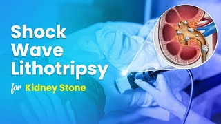 Laser Lithotripsy  Laser Kidney Stones  Setting Demonstration  Sydney NSW [upl. by Hachmin]