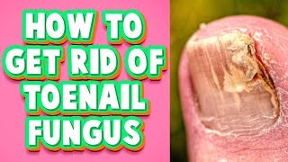 Toenail Fungus Treatment at Home A Fast Cure You Must Try [upl. by Neitsabes]