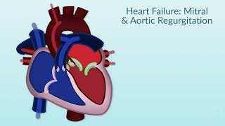 Rheumatic Heart Disease by E Rusingiza  OPENPediatrics [upl. by Thapa]