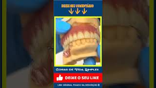 Prótese Dentária Grampos Metálicos e Prótese Dentária Total Diferenças Você já Viu [upl. by Matelda]