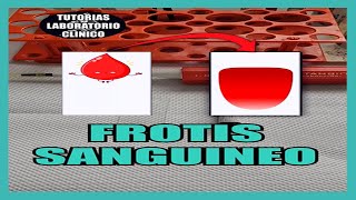 🩸¿Como Hacer un FROTIS SANGUÍNEO Extendido de Sangre Periférica 🔬Tutorial Laboratorio Clínico [upl. by Sternick142]