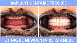 Implant dentaire en Turquie  Visite de Newdentaire à Istanbul [upl. by Toh3]