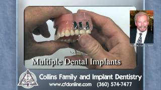 Partial dentures vs dental implants by Collins Family and Implant Dentistry Vancouver WA [upl. by Lawrence]