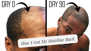 Microneedling for a Receding Hairline  Unedited Progress Pics [upl. by Podvin]