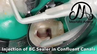 Obturation using BioCeramic Sealer with Single Cone Technique for Mesial Canals in Lower Molar  RCT [upl. by Nnyleuqcaj246]