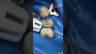 ¡🔥Eliminación de CARIES en los dientes sin DOLOR 😫🔥 [upl. by Gurney473]