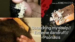 Scratching my scalp Extreme dandruff psoriasis [upl. by Grimona453]