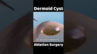 Dermoid Cyst Ablation Surgery [upl. by Ahsiekram]