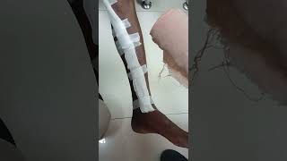 how to apply crepe bandage in leg side after bypass heart surgery medical health heart [upl. by Won]