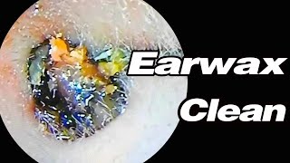 Ear Picking 8 Years Without Cleaning The Earwax Has Become Stones Very Hard To Remove耳掃除ASMR [upl. by East749]