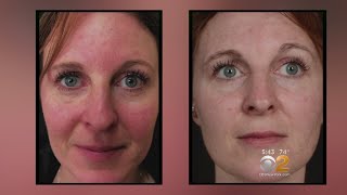 Health Watch New Laser Treatment For Rosacea [upl. by Anitsirhc]