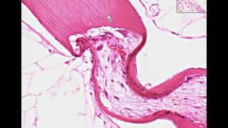 Histopathology BoneHyperparathyroidism [upl. by Ednil]