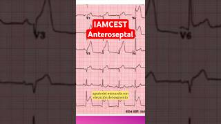 Infartó anteroseptal en el ECG medicina [upl. by Arathorn]