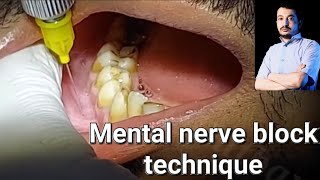 Local Anesthesia Mental Nerve block technique Mandibular Anesthesia Techniques dentistry [upl. by Notyalk302]