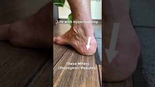 Life with hypermobility and Ehlers Danlos related symptoms flexibility [upl. by Michal373]