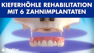 Kieferhöhle Rehabilitation mit 6 Zahnimplantaten © [upl. by Yahsel653]