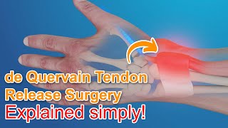 De Quervain Tendon Release Surgery  Explained [upl. by Anelys292]