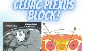 Celiac plexus block  Pain amp Palliative Medicine [upl. by Ennairej]